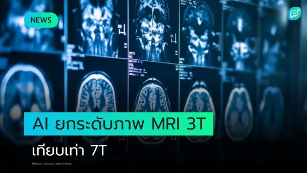 ภาพการสแกนสมองด้วย MRI 3T ที่ใช้ AI ยกระดับความคมชัด เทียบเท่ากับคุณภาพของ MRI 7T